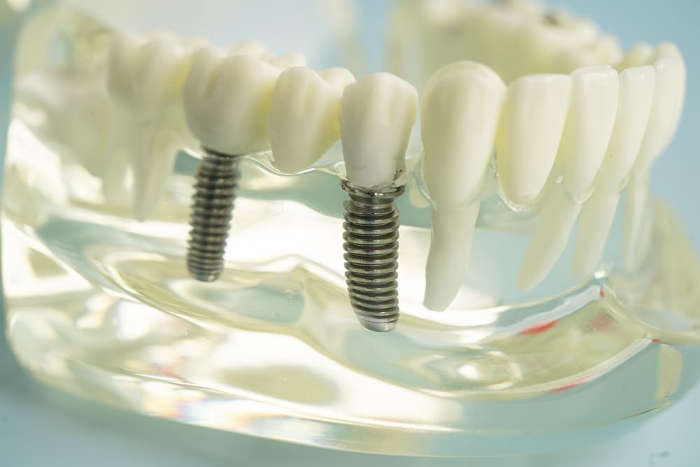 implantes dentales