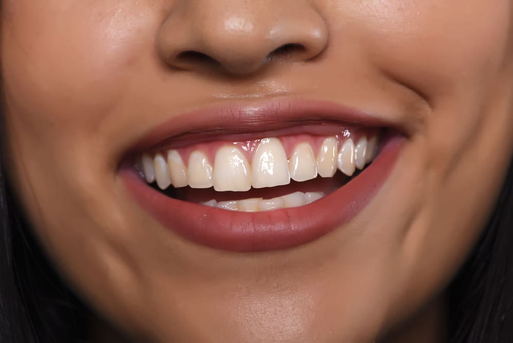 carillas dentales