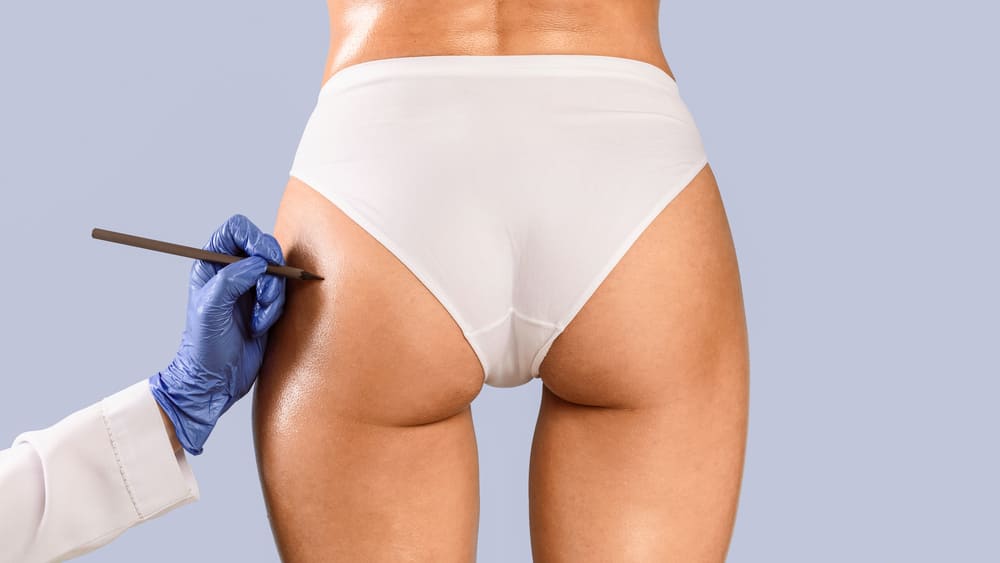 aumento de gluteo