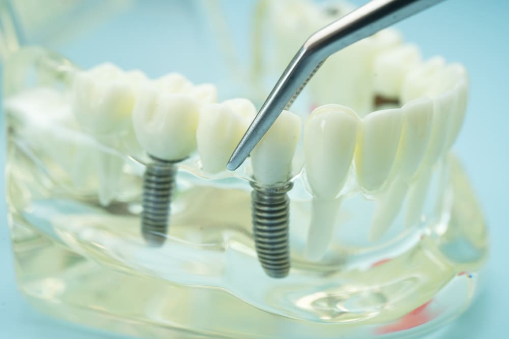 implante dental en Panamá