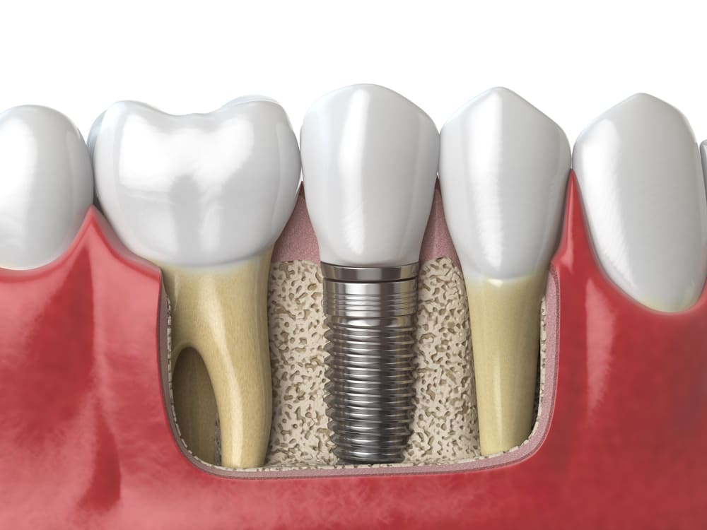 implantes dentales en Costa del Este, Panamá