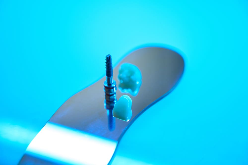 implantes dentales en Costa del Este, Panamá