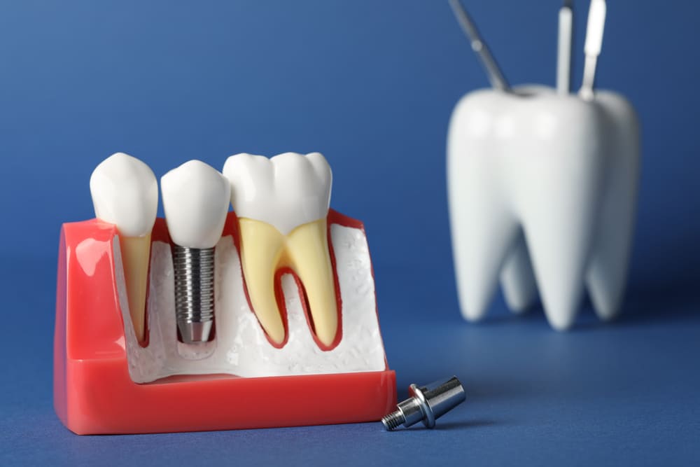 implantes dentales en Costa del Este, Panamá