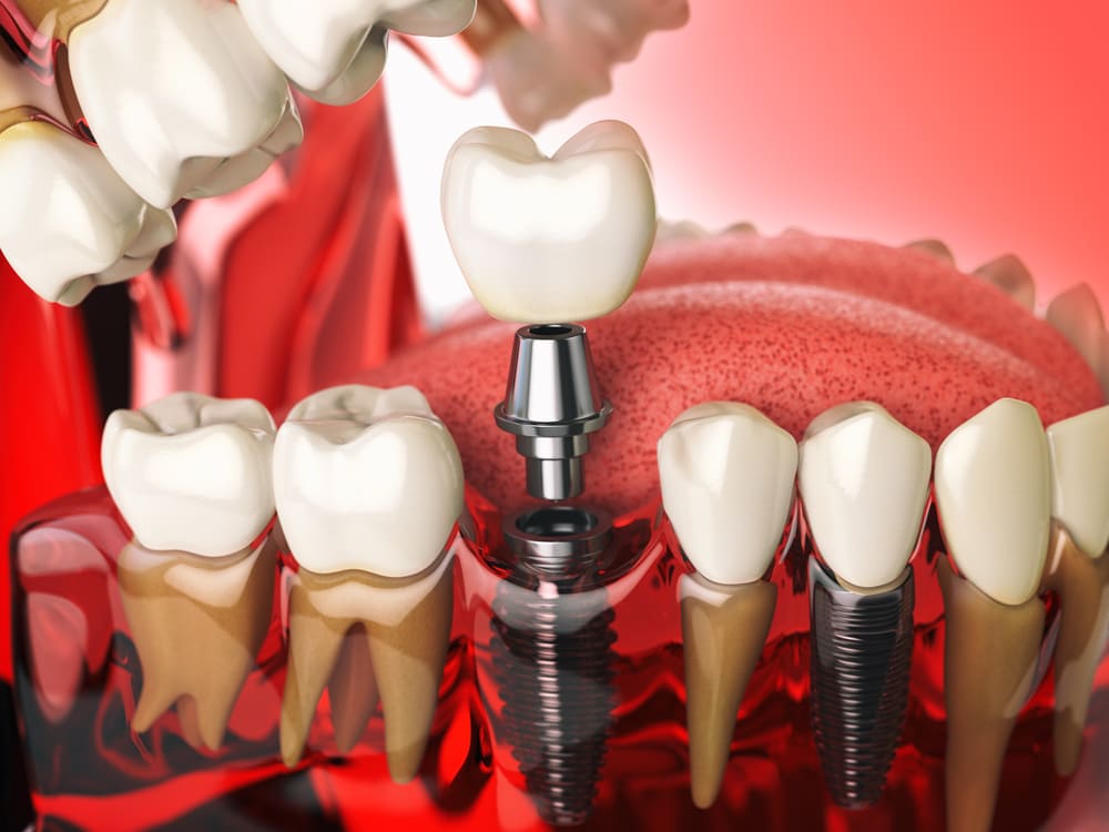 implantes dentales en Costa del Este, Panamá