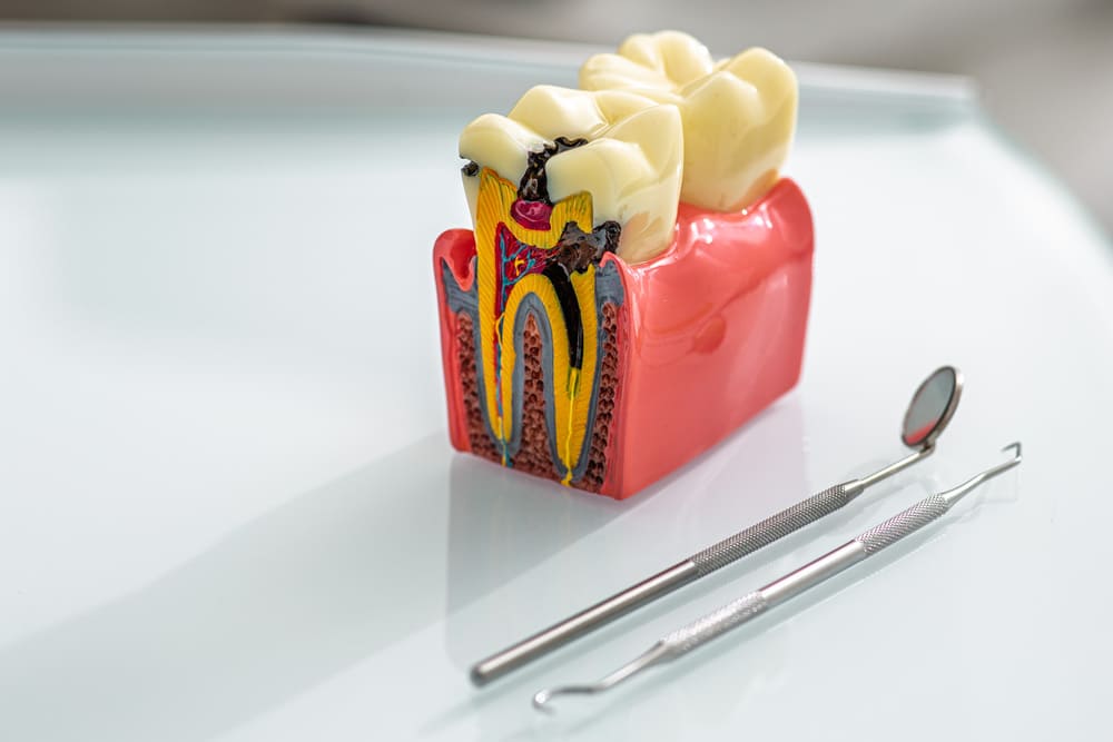 Endodoncia: la mejor solución en Panamá