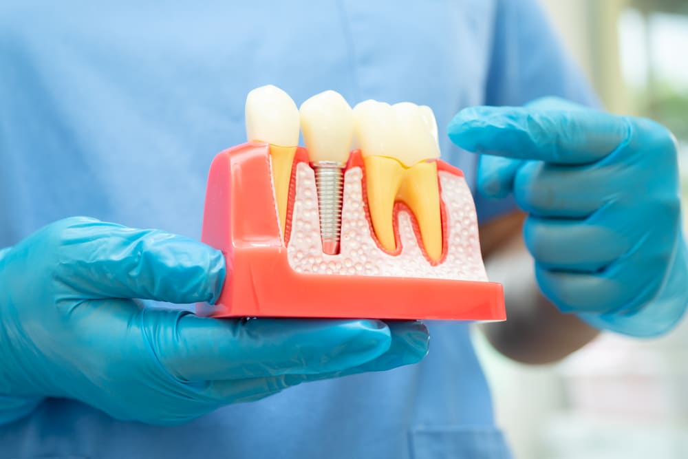 Opciones de tratamiento para pacientes con rehabilitación oral completa en Panamá