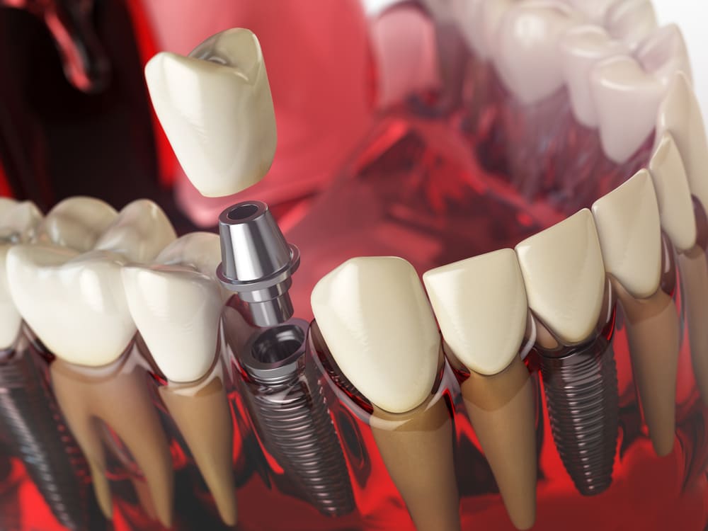 Atención integral para recuperar la función bucal con rehabilitación oral completa en Panamá